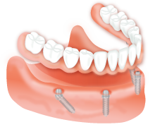 Dental Implants - All-on-Four