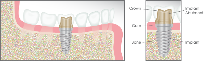 Dental Implant Illustration