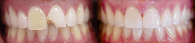 Porcelain Veneers - Before and After