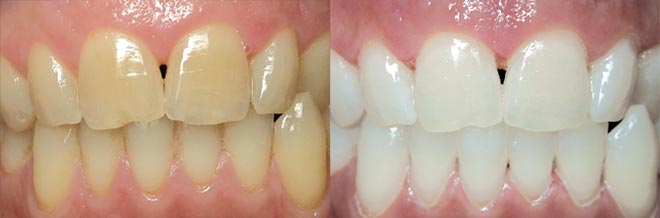 Teeth Whitening - Before and After